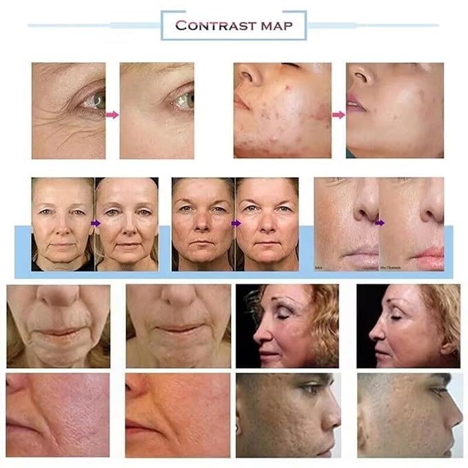 Anti-Aging Device, Wrinkle Reduction Beauty Care Equipment